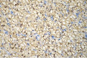 Immunohistochemistry was performed on paraffin-embedded human renal carcinoma using PPM1G antibody (ABIN7800035), 1:200).