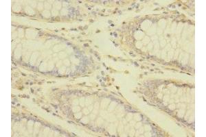 Immunohistochemistry of paraffin-embedded human colon cancer using ABIN7172869 at dilution of 1:100