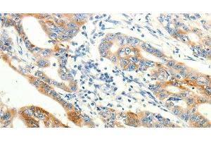 Immunohistochemistry of paraffin-embedded Human gasrtic cancer tissue using TRPA1 Polyclonal Antibody at dilution 1:60