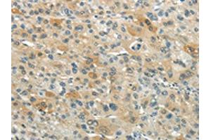 The image on the left is immunohistochemistry of paraffin-embedded Human liver cancer tissue using ABIN7193074(XKR3 Antibody) at dilution 1/20, on the right is treated with synthetic peptide. (XKR3 anticorps)