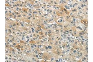 The image on the left is immunohistochemistry of paraffin-embedded Human liver cancer tissue using ABIN7193074(XKR3 Antibody) at dilution 1/20, on the right is treated with synthetic peptide.