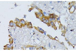 Immunohistochemistry of paraffin-embedded Human lung cancer using ACADL Polyclonal Antibody at dilution of 1:100 (40x lens). (ACADL anticorps)