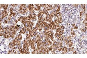 ABIN6278960 at 1/100 staining Human liver cancer tissue by IHC-P. (XCR1 anticorps)