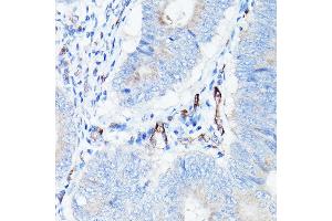Immunohistochemistry of paraffin-embedded human colon carcinoma using CDH5 Rabbit pAb (ABIN6134029, ABIN6138297, ABIN6138298 and ABIN6216033) at dilution of 1:150 (40x lens).