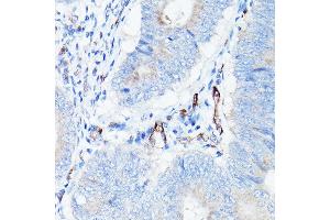 Immunohistochemistry of paraffin-embedded human colon carcinoma using CDH5 Rabbit pAb (ABIN6134029, ABIN6138297, ABIN6138298 and ABIN6216033) at dilution of 1:150 (40x lens). (Cadherin 5 anticorps  (AA 650-750))
