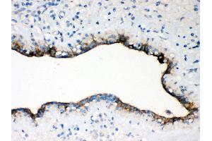 Anti- Occludin antibody,IHC(P) IHC(P): Human Mammary Cancer Tissue
