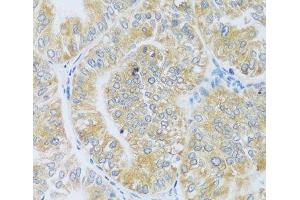 Immunohistochemistry of paraffin-embedded Human uterine cancer using ASB4 Polyclonal Antibody at dilution of 1:100 (40x lens). (ASB4 anticorps)