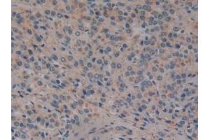 DAB staining on IHC-P; Samples: Human Prostate cancer Tissue (GP2 anticorps  (AA 307-512))