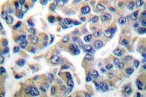 Immunohistochemical analysis of EEF2K polyclonal antibody  in paraffin-embedded human breast carcinoma tissue. (EEF2K anticorps)