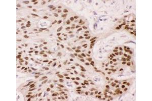 IHC-P: p63 antibody testing of human oesophagus squama cancer tissue