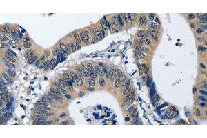 Immunohistochemistry of paraffin-embedded Human colon cancer using NFKBID Polyclonal Antibody at dilution of 1:40 (NFKBID anticorps)