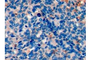 Detection of PD1 in Human Ovarian cancer Tissue using Monoclonal Antibody to Programmed Cell Death Protein 1 (PD1)