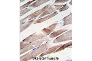 Formalin-fixed and paraffin-embedded human hepatocarcinoma tissue reacted with the primary antibody, which was peroxidase-conjugated to the secondary antibody, followed by DAB staining.