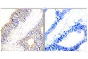 Immunohistochemistry analysis of paraffin-embedded human colon carcinoma tissue using Stefin A antibody. (CSTA anticorps  (Internal Region))