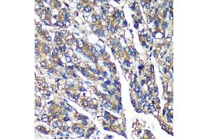 Immunohistochemistry of paraffin-embedded Human liver cancer using FBXO21 Rabbit pAb (ABIN7267085) at dilution of 1:100 (40x lens).