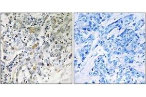 Immunohistochemistry analysis of paraffin-embedded human breast carcinoma tissue, using ELL2 Antibody. (ELL2 anticorps  (AA 448-497))