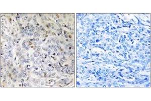 Immunohistochemistry analysis of paraffin-embedded human breast carcinoma tissue, using PDIK1L Antibody.
