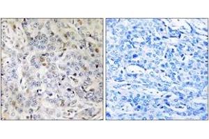 Immunohistochemistry analysis of paraffin-embedded human breast carcinoma tissue, using PDIK1L Antibody. (PDIK1L anticorps  (AA 101-150))