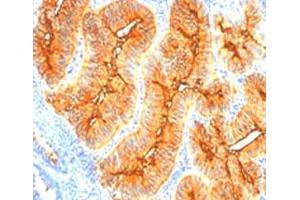 Immunohistochemical staining (Formalin-fixed paraffin-embedded sections) of human colon cancer with tag-72 monoclonal antibody, clone SPM148 .
