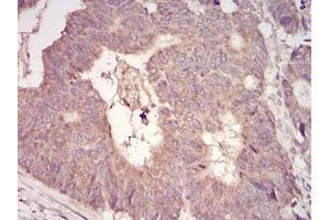 Immunohistochemical analysis of paraffin-embedded rectum cancer tissues using MuRF1 mouse mAb with DAB staining. (TRIM63 anticorps  (AA 293-304))
