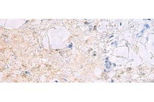 Immunohistochemistry of paraffin-embedded Human gastric cancer tissue using DPCD Polyclonal Antibody at dilution of 1:50(x200) (DPCD anticorps)