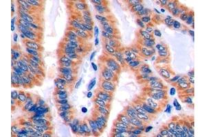 Detection of PDL2 in Human Thyroid cancer Tissue using Polyclonal Antibody to Programmed Cell Death Protein 1 Ligand 2 (PDL2) (PDCD1LG2 anticorps  (AA 33-236))