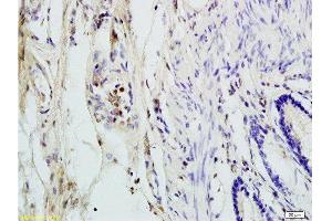 Formalin-fixed and paraffin embedded human colon carcinoma labeled with Rabbit Anti ANP32C Polyclonal Antibody, Unconjugated  at 1:200 followed by conjugation to the secondary antibody and DAB staining