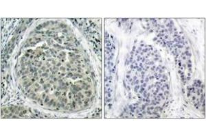 Immunohistochemistry analysis of paraffin-embedded human breast carcinoma, using Catenin-beta (Phospho-Ser37) Antibody.