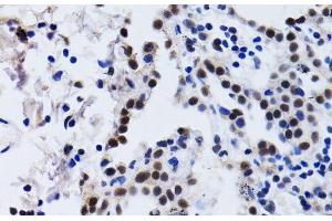 Immunohistochemistry of paraffin-embedded Human lung cancer using ID3 Polyclonal Antibody at dilution of 1:200 (40x lens).