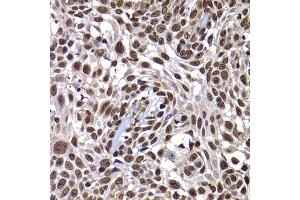 Immunohistochemistry of paraffin-embedded human well-differentiated squamous skin carcinoma using DNAJB6 antibody at dilution of 1:100 (x400 lens). (DNAJB6 anticorps)