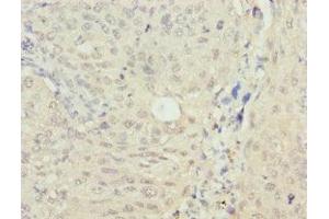 Immunohistochemistry of paraffin-embedded human lung cancer using ABIN7160268 at dilution of 1: 100