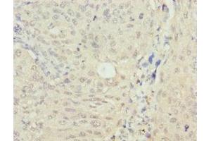 Immunohistochemistry of paraffin-embedded human lung cancer using ABIN7160268 at dilution of 1: 100 (RAE1 anticorps  (AA 1-368))