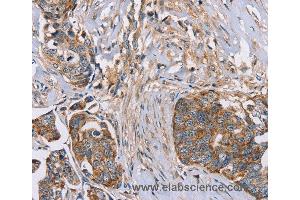 Immunohistochemistry of Human cervical cancer using FAIM2 Polyclonal Antibody at dilution of 1:30 (FAIM2 anticorps)