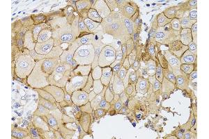 Immunohistochemistry of paraffin-embedded human breast cancer using PDE4D antibody (ABIN5970821) at dilution of 1/100 (40x lens). (PDE4D anticorps)
