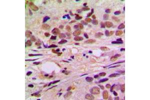 Immunohistochemical analysis of Cyclin L1 staining in human breast cancer formalin fixed paraffin embedded tissue section. (Cyclin L1 anticorps  (C-Term))