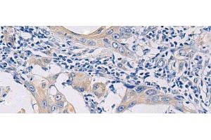 Immunohistochemistry of paraffin-embedded Human esophagus cancer tissue using GALR3 Polyclonal Antibody at dilution of 1:50(x200) (GALR3 anticorps)