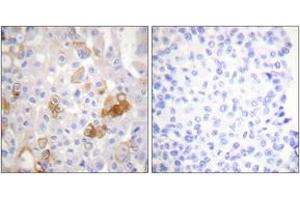 Immunohistochemistry analysis of paraffin-embedded human breast carcinoma, using Integrin beta1 (Phospho-Thr788) Antibody.