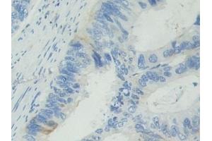 Detection of BCAM in Human Colorectal cancer Tissue using Polyclonal Antibody to Basal Cell Adhesion Molecule (BCAM)