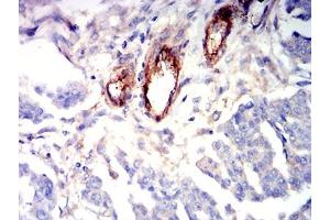 Immunohistochemical analysis of paraffin-embedded ovarian cancer tissues using CD363 mouse mAb with DAB staining.