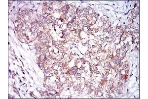 Immunohistochemical analysis of paraffin-embedded bladder cancer tissues using CAMK2G mouse mAb with DAB staining.