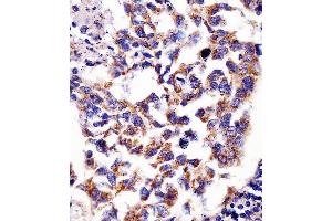 (ABIN6242390 and ABIN6578681) staining Hsp60 in human lung adenocarcinoma tissue sections by Immunohistochemistry (IHC-P - paraformaldehyde-fixed, paraffin-embedded sections). (HSPD1 anticorps  (AA 396-430))
