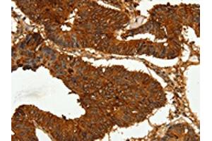 The image on the left is immunohistochemistry of paraffin-embedded Human colon cancer tissue using ABIN7128894(CEACAM21 Antibody) at dilution 1/60, on the right is treated with fusion protein. (CEACAM21 anticorps)