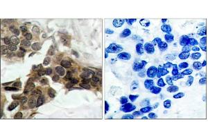 Immunohistochemical analysis of paraffin-embedded human breast carcinoma tissue, using IκB-α (phospho-Ser32/Ser36) antibody (E011152) . (NFKBIA anticorps  (pSer32, pSer36))