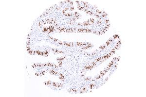Strong nuclear PAX8 staining of a subset of epithelial cells in the fallopian tube