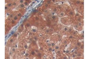 Detection of PYGL in Human Liver cancer Tissue using Polyclonal Antibody to Glycogen Phosphorylase, Liver (PYGL)