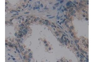 Detection of VIL in Human Prostate Tissue using Polyclonal Antibody to Villin (VIL) (Villin 1 anticorps  (AA 1-320))
