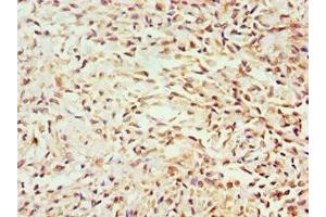 Immunohistochemistry of paraffin-embedded human breast cancer using ABIN7154587 at dilution of 1:100