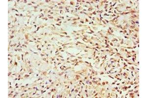 Immunohistochemistry of paraffin-embedded human breast cancer using ABIN7154587 at dilution of 1:100 (GEM anticorps  (AA 1-150))