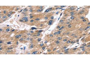 Immunohistochemistry of paraffin-embedded Human liver cancer tissue using SRGN Polyclonal Antibody at dilution 1:25 (SRGN anticorps)