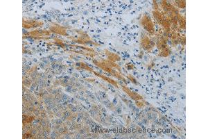 Immunohistochemistry of Human liver cancer using NPHS1 Polyclonal Antibody at dilution of 1:40 (Nephrin anticorps)